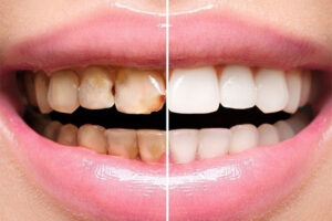 Что входит в реставрацию зубов
